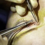 eyelid surgery scar anatomy