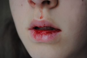           Kỹ thuật phun xăm thiếu chuyên nghiệp sẽ khiến đôi môi nứt chảy máu