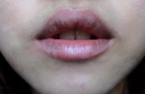 Phun môi bị thâm loang: Nguyên nhân và cách khắc phục