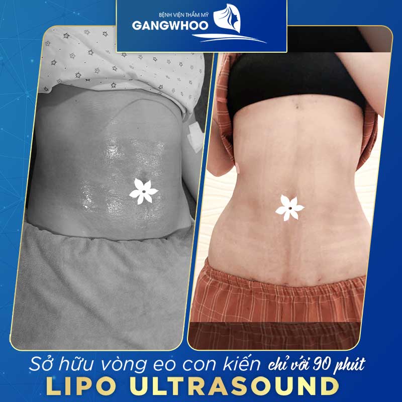 Thẩm mỹ viện GangWhoo ứng dụng nhiều phương pháp giảm béo bụng cao cấp