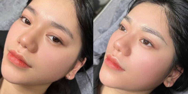 Vệ sinh môi bằng nước muối sinh lý để hạn chế nhiễm trùng
