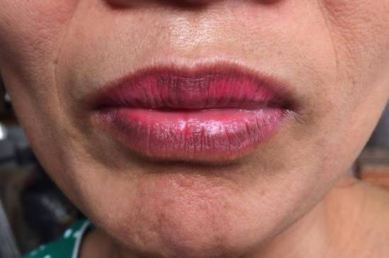 Phun môi không ủ tê có thể cảm nhận được cảm giác hơi châm chích trong quá trình thực hiện