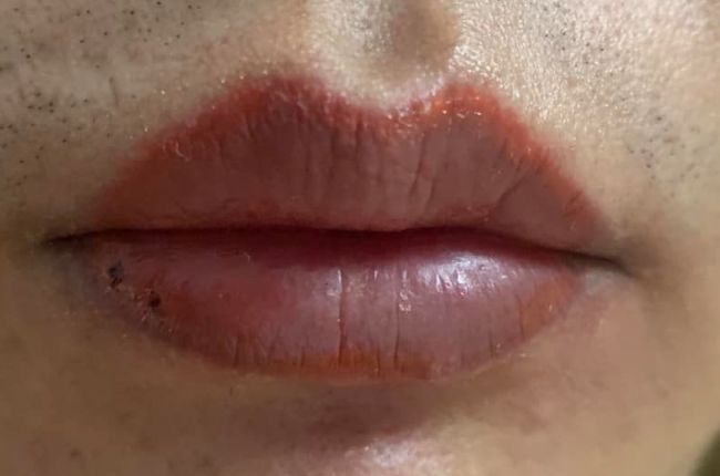 Xăm môi bị đậm viền thường do nhiều nguyên nhân khác nhau