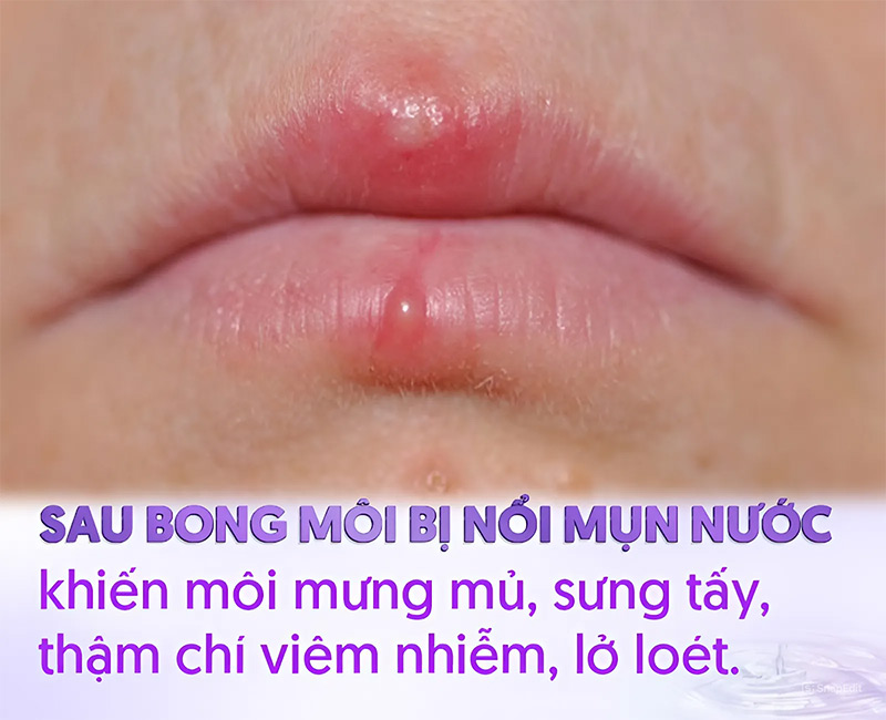 Cần bổ sung dinh dưỡng và có chế độ chăm sóc môi kịp thời sau khi bị mụn nước