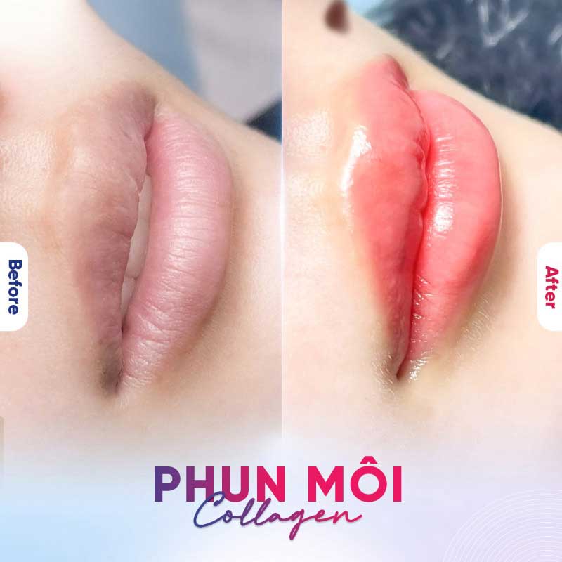 Phun môi collagen là công nghệ phổ biến giúp cải thiện sắc môi
