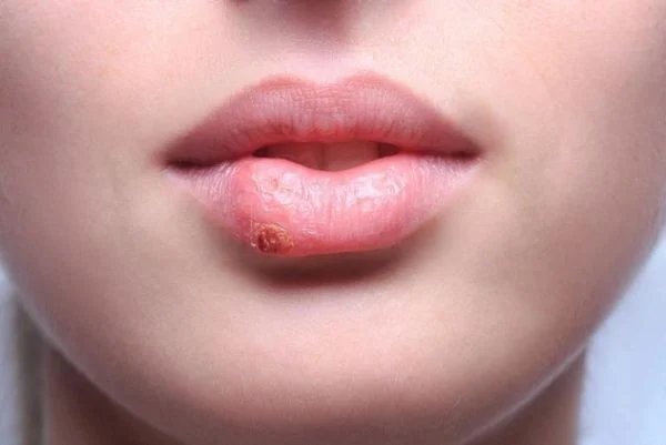 Nên nắm rõ tình trạng mụn nước và thời điểm để có giải pháp xử lý kịp thời