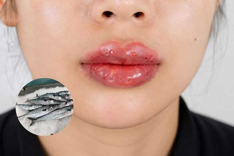 Hàm lượng muối mặn đậm đặc cùng histamine trong cá muối tiềm ẩn nguy cơ gây kích ứng, xót rát và thâm sạm màu môi