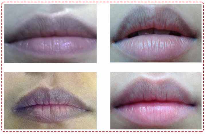 Nhận diện đúng nguyên nhân gây thâm viền môi là bước tiên quyết để lựa chọn phác đồ khắc phục hiệu quả