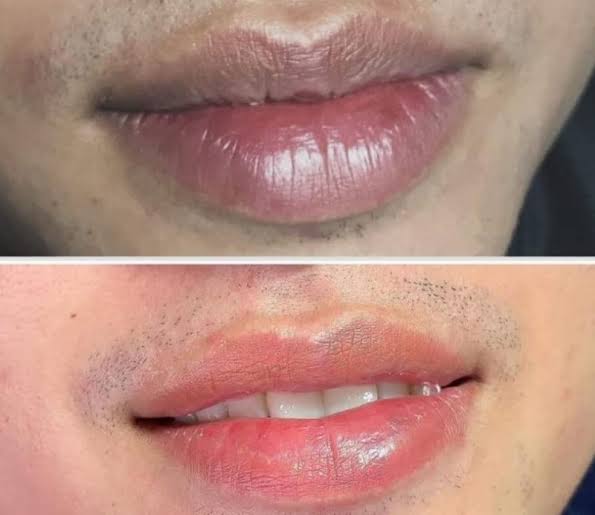 Nắm rõ nguyên nhân gây tăng sắc tố và cơ chế trung hòa màu giúp phái mạnh lựa chọn phác đồ khử thâm môi chuẩn xác
