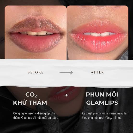 Ứng dụng công nghệ xử lý sắc tố vi điểm cùng quy trình ủ tê chuẩn y khoa giúp khử thâm môi diễn ra êm ái, hoàn toàn nhẹ nhàng