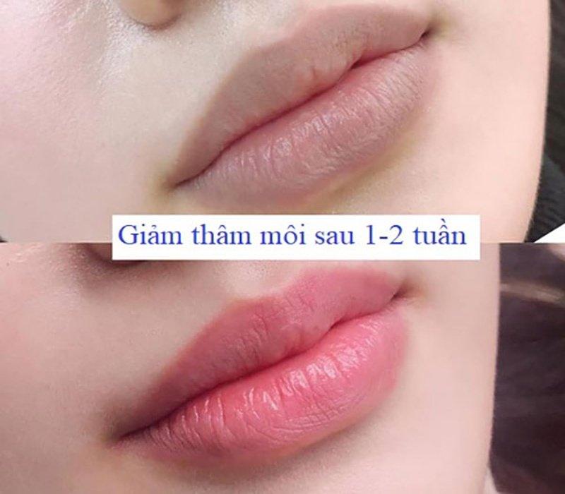 Mức độ cảm giác thực tế khi khử thâm môi và những yếu tố cốt lõi giúp quá trình thực hiện luôn dễ chịu