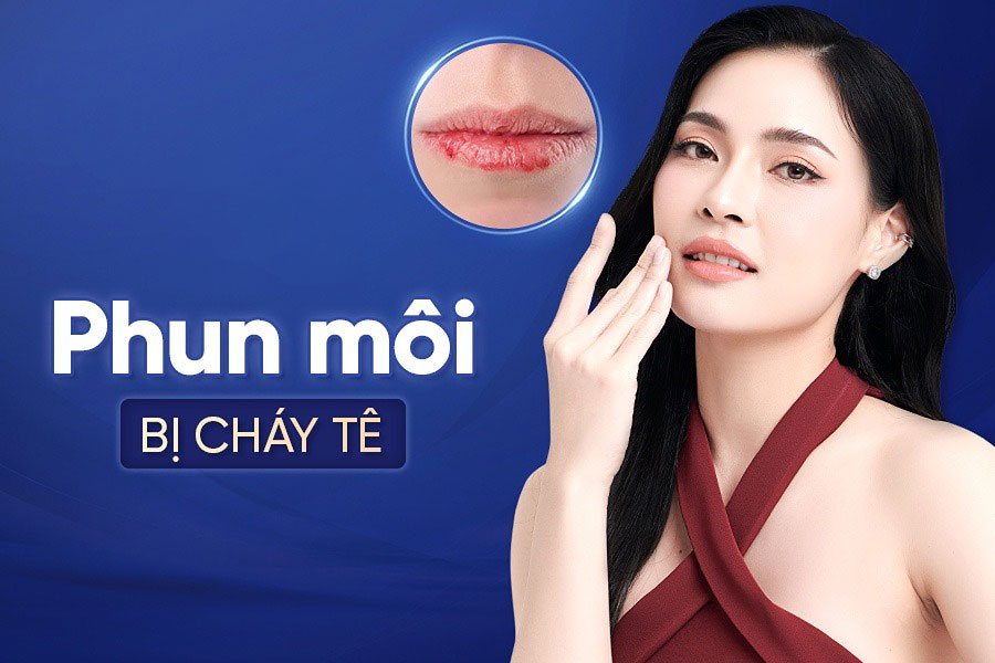 Nhận diện sớm tình trạng cháy tê môi và áp dụng phác đồ xử lý kịp thời giúp tái sinh nền da non, trả lại bờ môi mềm mại
