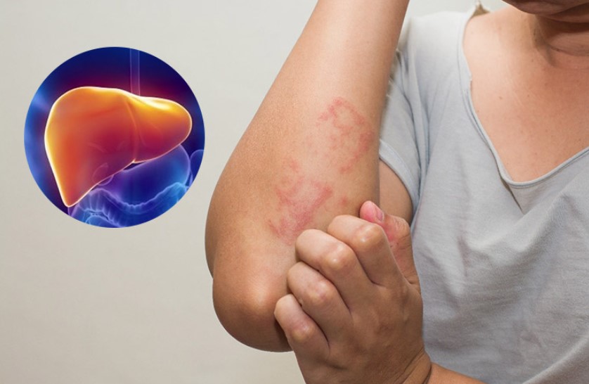 Người bị bệnh gan thì không nên ăn trứng vịt lộn Người bị bệnh gan thì không nên ăn trứng vịt lộn