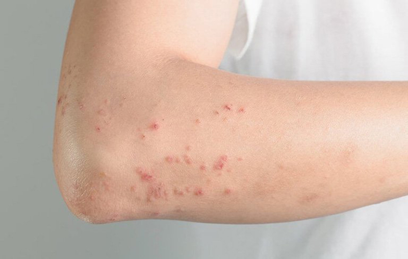 Tiếp xúc với da ghế massage bị ẩm có thể dẫn đến mẩn ngứa Tiếp xúc với da ghế massage bị ẩm có thể dẫn đến mẩn ngứa