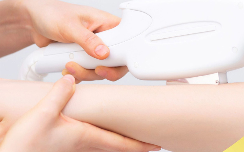 Triệt lông đầu lạnh không gây bỏng rát cho da 