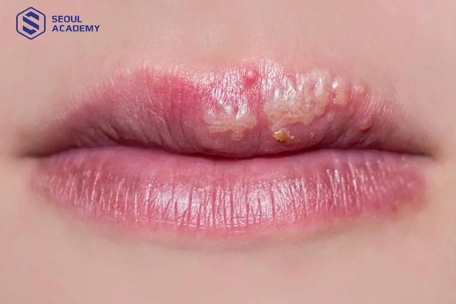 Mụn nước lan rộng và nặng hơn