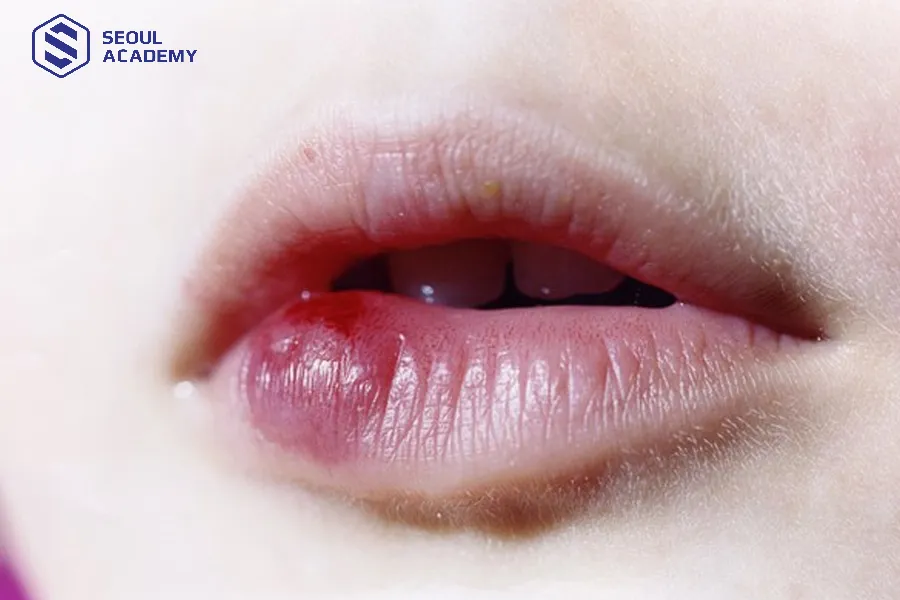 Mụn nước trở nặng và sưng to hơn