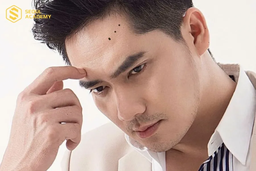 Nốt ruồi thẳng hàng trên trán vô cùng hiếm Nốt ruồi thẳng hàng trên trán vô cùng hiếm