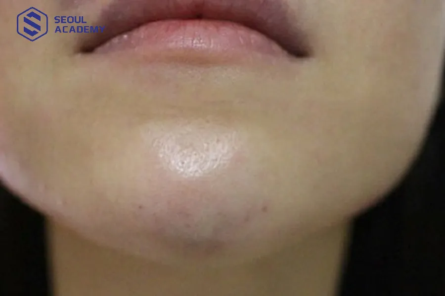 Cằm sưng và tím nhiều ngày cũng là dấu hiệu của hoại tử filler