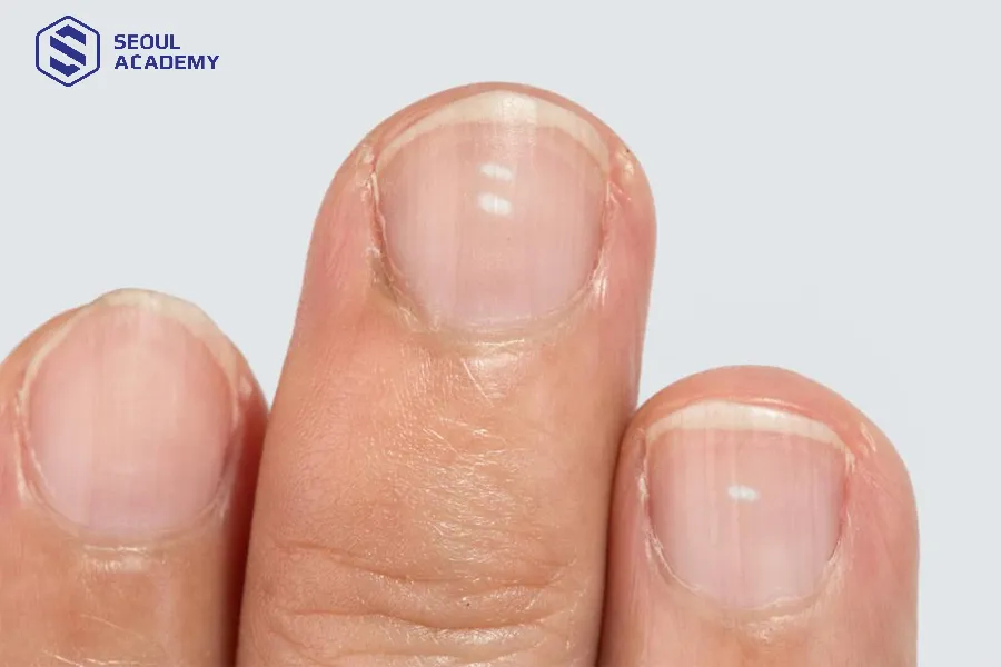 Tình trạng móng đang bị tổn thương