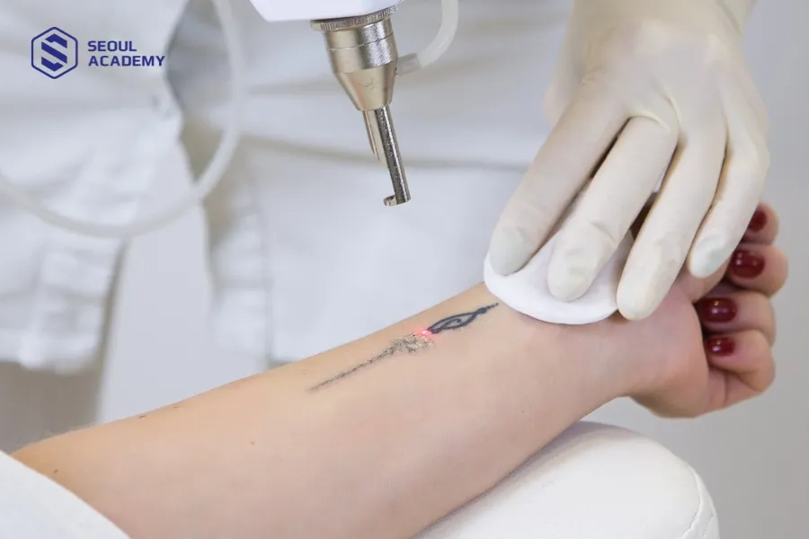 Ứng dụng tia laser để xóa xăm