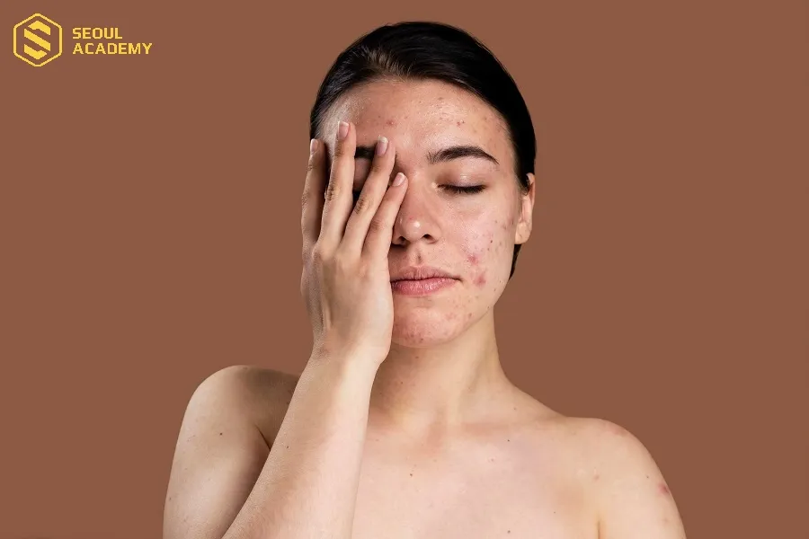 Da mụn vẫn có thể massage khi rửa mặt nhưng thao tác cần nhẹ nhàng Da mụn vẫn có thể massage khi rửa mặt nhưng thao tác cần nhẹ nhàng