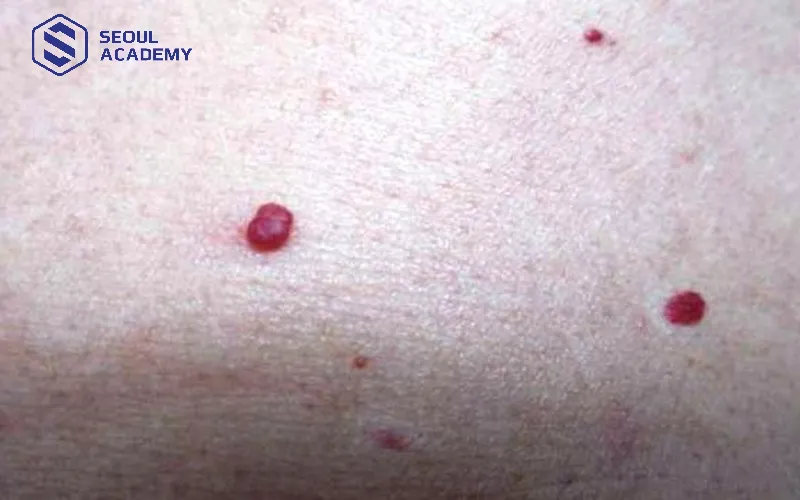 Nốt ruồi son được xem là dấu hiệu của sự may mắn và tài lộc