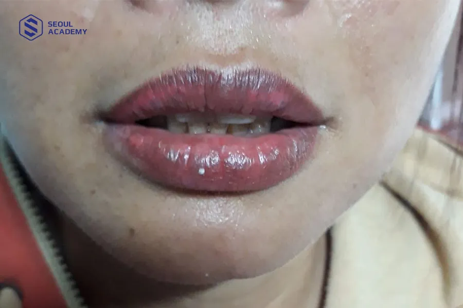 Phun môi bị cháy tê là một sự cố xảy ra trong quá trình phun xăm