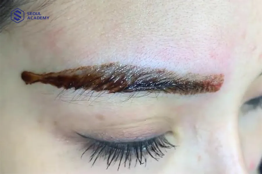 Xóa hình xăm bằng dung dịch có tốt không là vấn đề khiến chị em băn khoăn