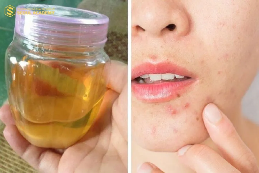 Mỡ trăn có công dụng hỗ trợ điều trị các nốt mụn viêm, mụn mủ,...