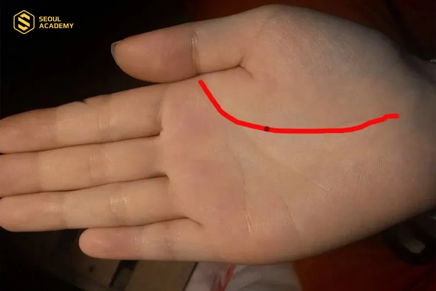 Đường sinh đạo có nốt ruồi là đặc điểm của chỉ tay chết sớm