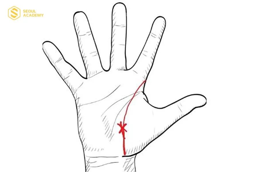 Đường sinh đạo bị chỉ tay khác chồng chéo lên