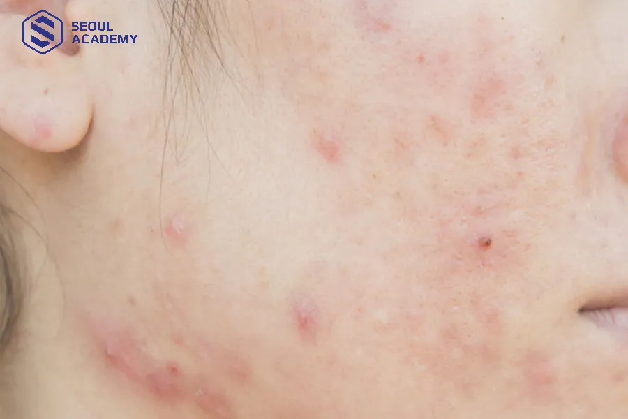 Da mụn không được hấp trắng