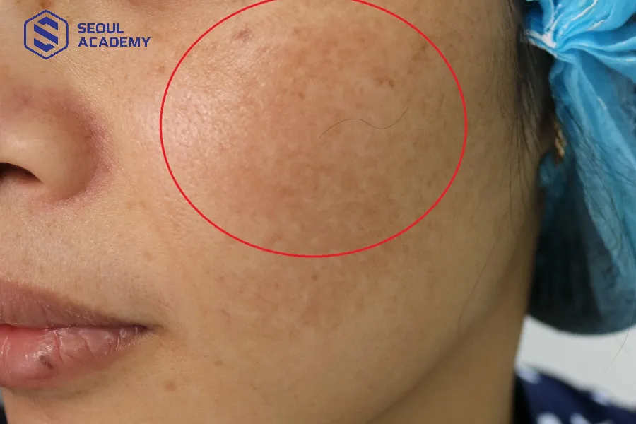 Hãy tận dụng các cơ hội trong cuộc sống khi thấy lông tài trên má