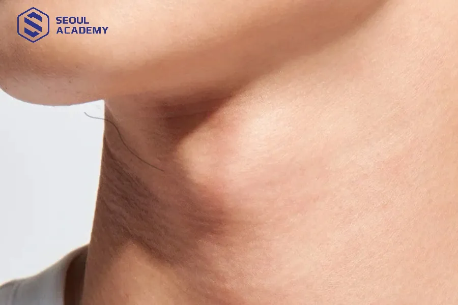 Lông tài xuất hiện ở vùng cổ khá phổ biến