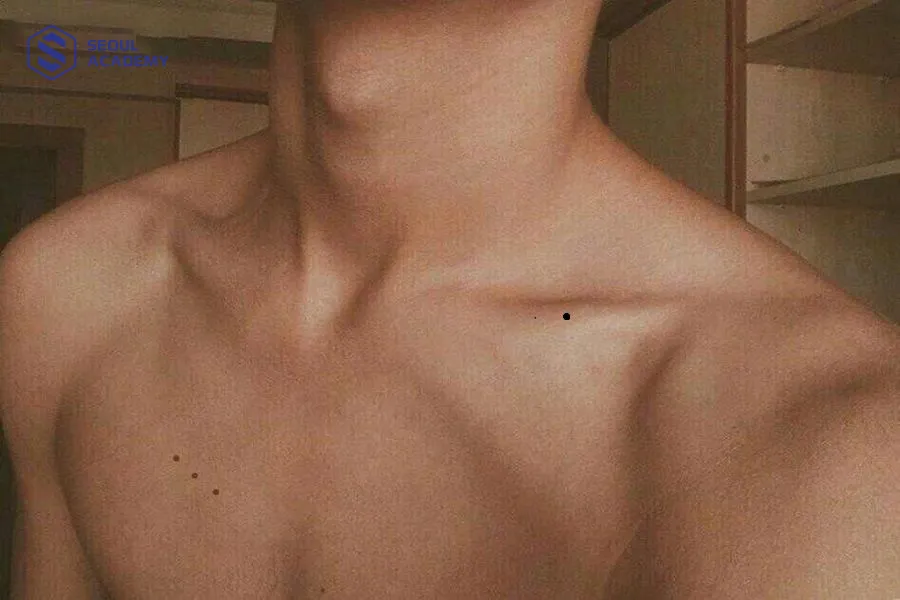 Nam giới có nốt ruồi ở xương quai xanh bên phải