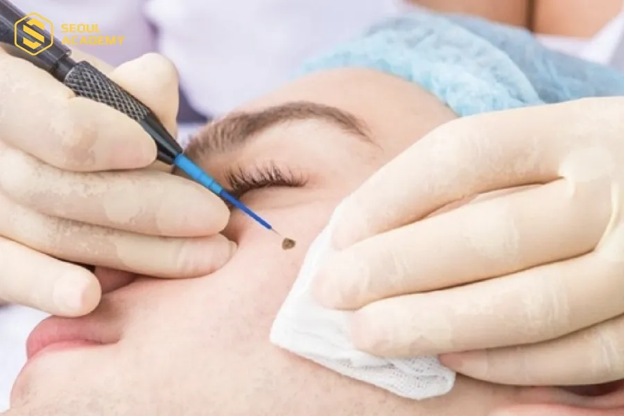 Tùy từng trường hợp mà mọi người có thể xoá nốt ruồi hoặc không