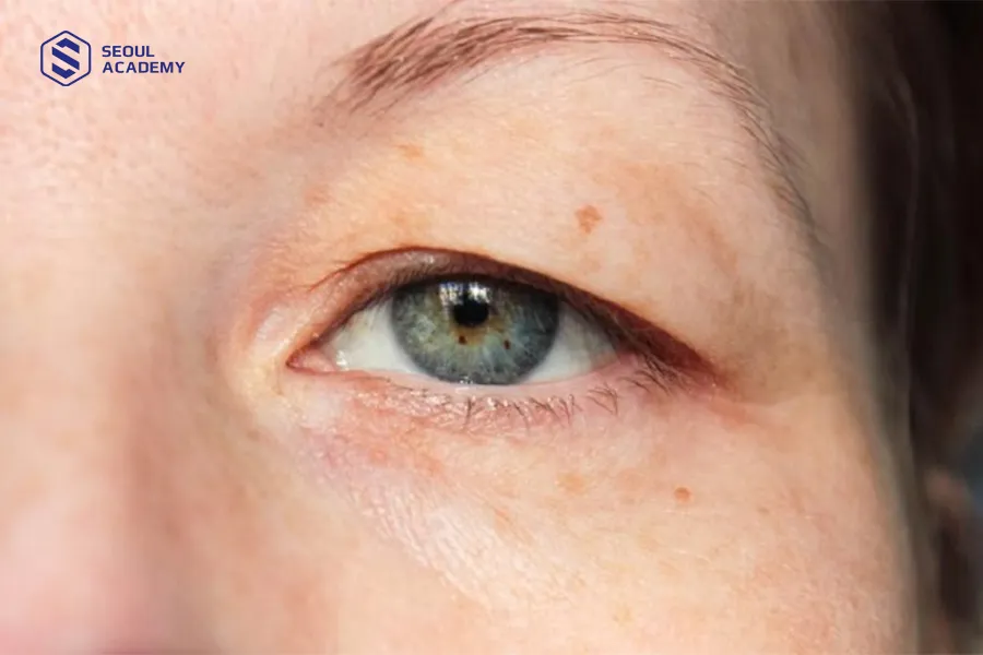 Tướng đuôi mắt cụp xuống có phần mí bị chùng xuống dưới