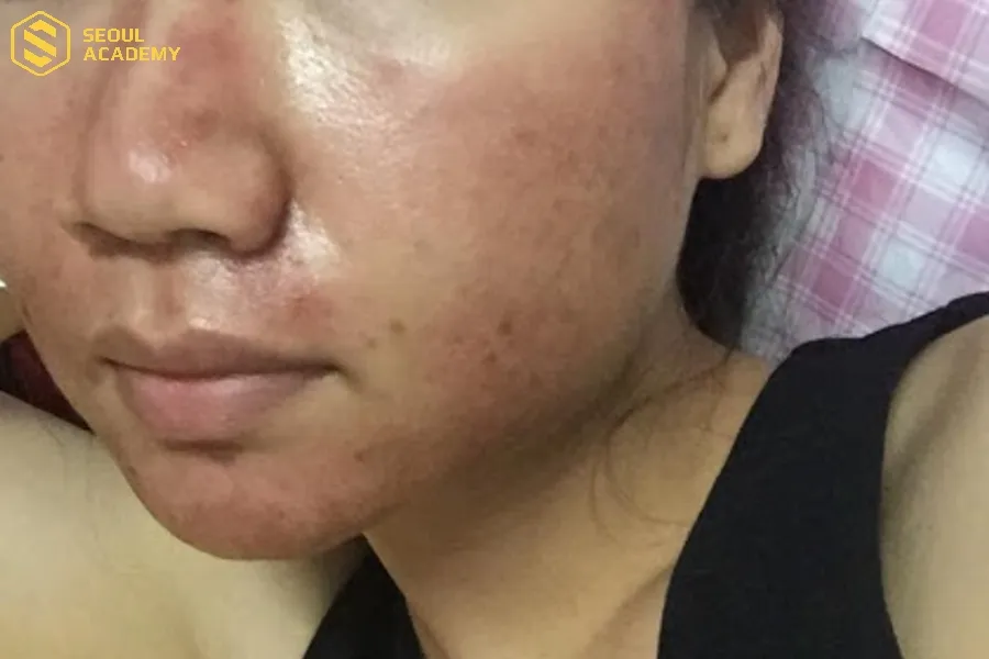 Trong 3 ngày đầu tiên cần chú ý vào khâu vệ sinh, làm dịu da