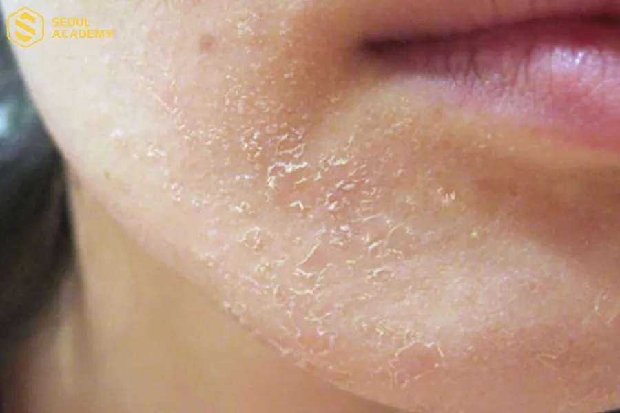 Làn da có các dấu hiệu bong tróc sau 3 ngày lăn kim