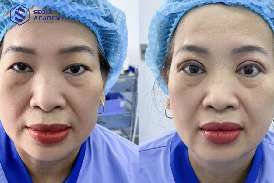 Chọn điểm dạy cắt mí uy tín rất quan trọng