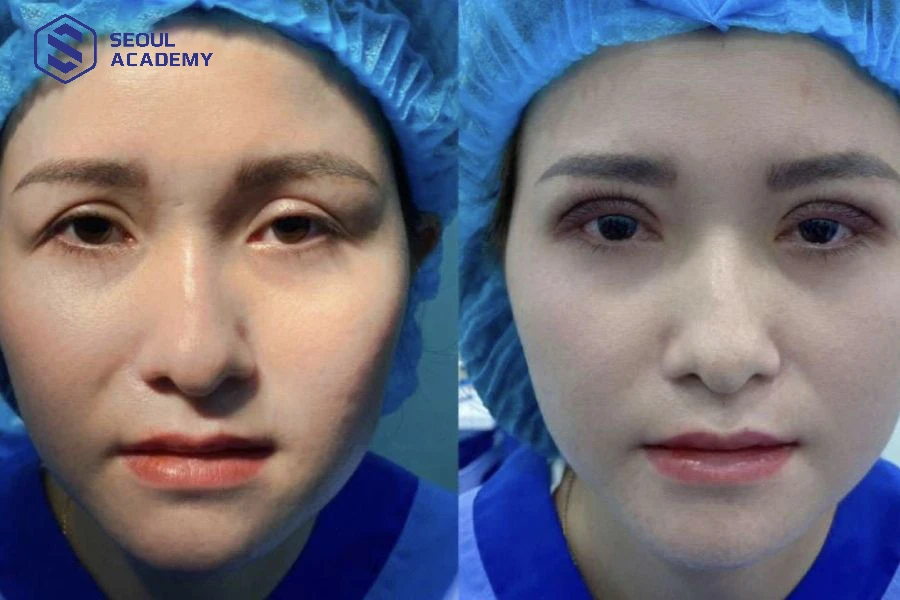 Thẩm mỹ viện Thuỳ Dương nổi tiếng trong cắt mí và dạy nghề