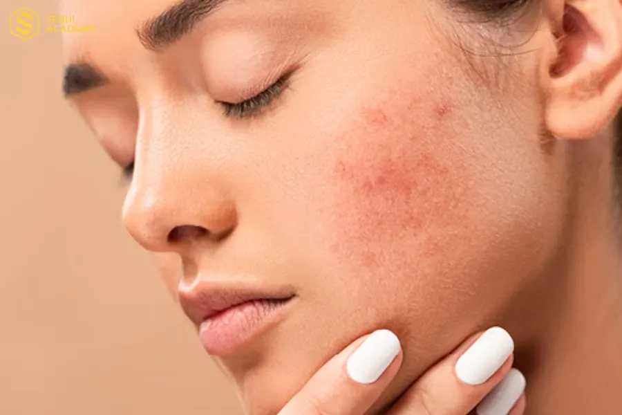 Ngừng sử dụng các sản phẩm nhiều thành phần hóa học để hạn chế kích ứng