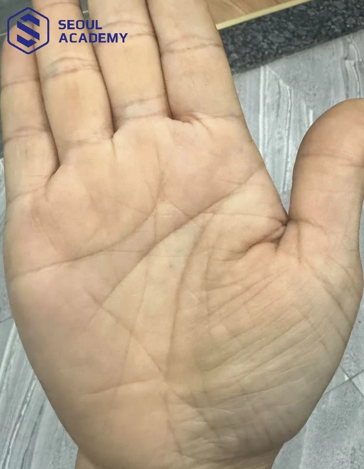 Bàn tay có cờ lệnh là dấu hiệu vô cùng hiếm gặp