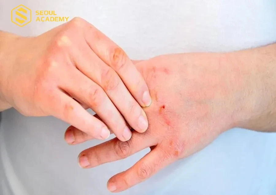 Viêm da cơ địa là tình trạng da khô, ngứa, đỏ bong tróc xuất hiện ở nhiều vùng trên cơ thể