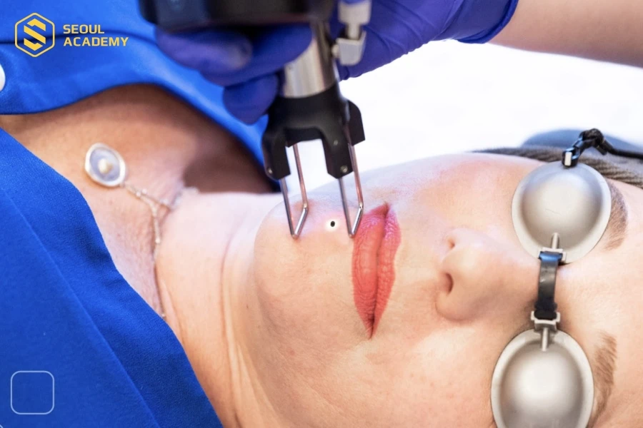 Tẩy nốt ruồi công nghệ cao an toàn hơn