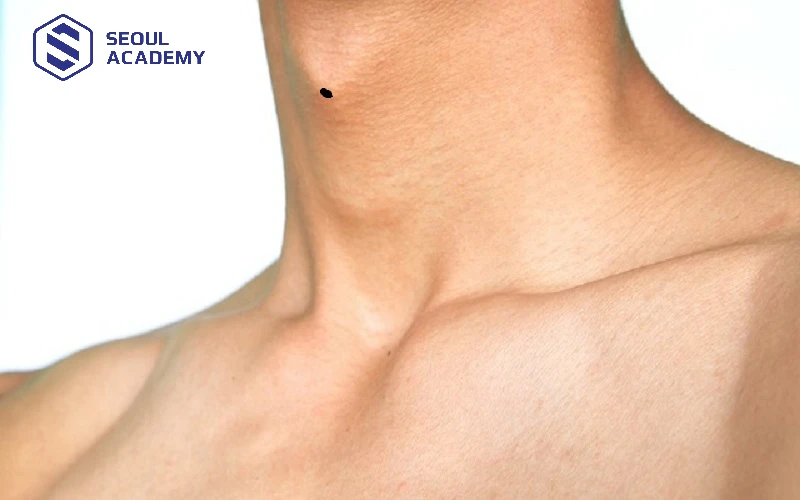 Nốt ruồi giữa yết hầu khá hiếm gặp