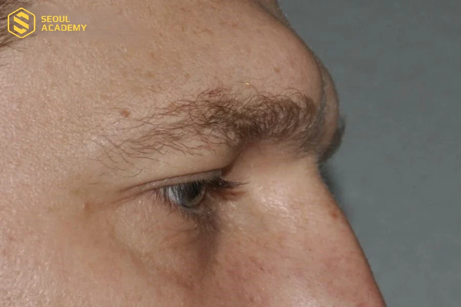 Đặc trưng tướng mày nhô cao thường kết hợp với hốc mắt sâu