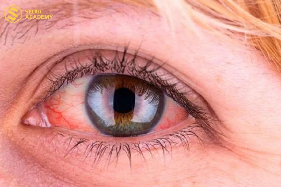 Nguyên nhân gây dị ứng keo nối mi do nhiều yếu tố khác nhau