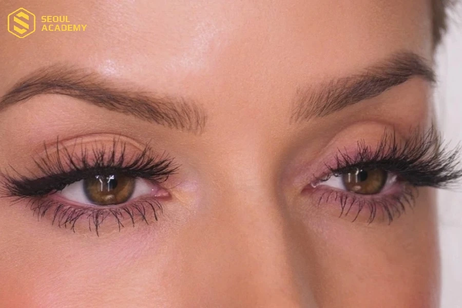 Mắt bị sưng đỏ là một trong những dấu hiệu dị ứng keo nối phổ biến ở nhiều người